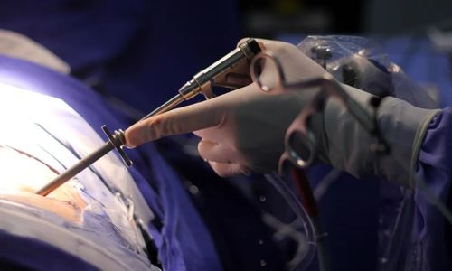 Cirurgia Endoscópica de Coluna