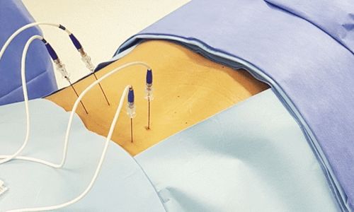 Facetárias coluna lombar